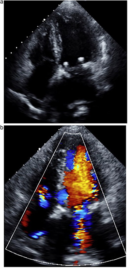 One week postoperative transthoracic echocardiography. (a) The left atrium was reduced in size. (b) Mitral regurgitation was well controlled.