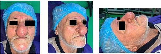 Preoperative view; showing a 70-year-old male with nasal soft tissue swelling, irregular in shape, no ulceration, no bleeding, and lesion confined to the nose.