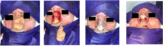 Intraoperative view.
