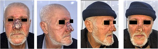 Postoperative view (a few months after surgery).