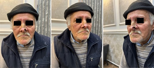 Postoperative view (a long-term follow-up at 2 years).