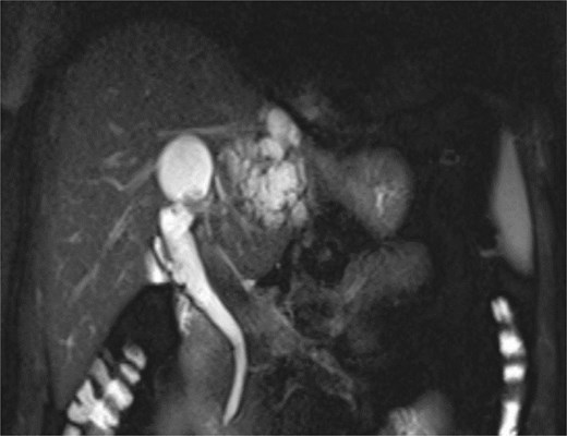 MRCP demonstrates multiple hyperintense, cystic lesions representing dilated intrahepatic bile ducts in the left hepatic lobe.
