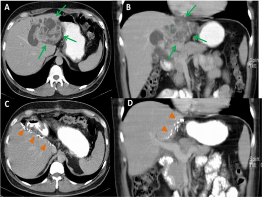 Preoperative CT images, axial (A) and coronal (B) planes, show a large, polycystic lesion in the left hepatic lobe (arrows), dilated intrahepatic bile ducts, and the “central dot” sign (*). Postoperative axial (C) and coronal (D) CT images after left hemihepatectomy show no focal lesion in the right hepatic lobe.