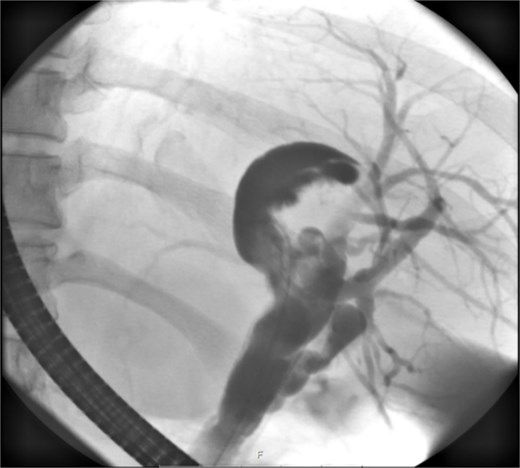 ERCP reveals a crescent-shaped, contrast-enhancing structure (40 mm in length) originating from the left hepatic duct.