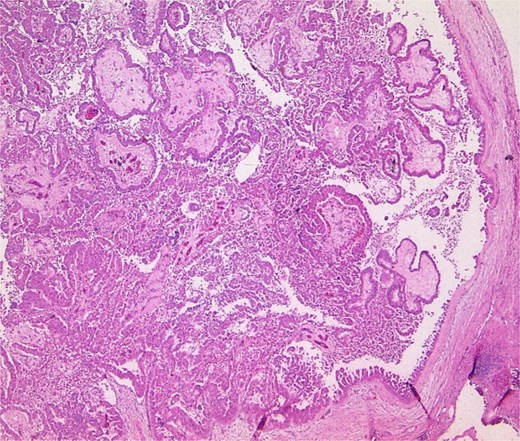Pathology specimen shows markedly cystic dilated intrahepatic bile ducts with infiltrating adenocarcinoma.