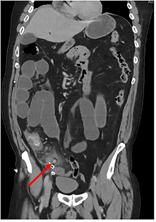 Coronal CT scan depicting Surgicel® as a tubular structure containing gas. (Created by authors)