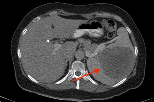 Axial CT image depicting the splenic mass (arrow).