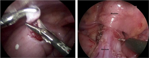 Frozen section biopsy and dissection of the sigmoid colon and rectum down to the pelvic cavity.