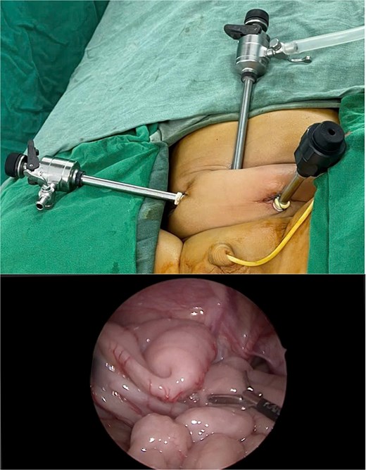 Position of trocar placement and intraoperative observation.