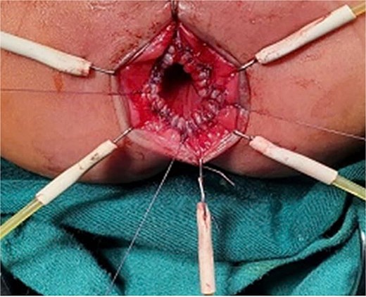 Pull-through surgery combined with Swenson-like technique.