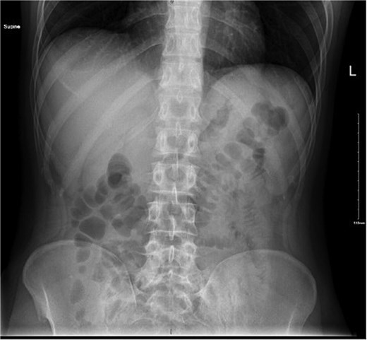 Abdominal X-ray showing no air under diaphragm.