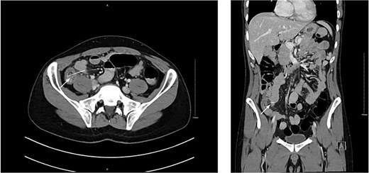CT scan showing linear hyperdense structure (arrow) within the terminal ileum perforating medially.