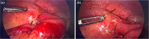 Intra operative findings. (a) Demonstrating the toothpick protruding from the ileal wall. (b) The toothpick after extraction.