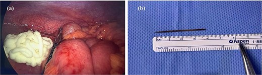 (a) Demonstrates the surgifoam applied on the previous FB site. (b) The toothpick, measuring 4 cm.