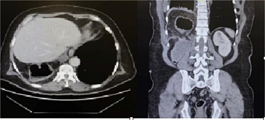 CT scan of the abdomen revealed a herniated obstructed segment of large bowel loops and mesenteric fat at the hepatic flexure, likely through the posterior right hemidiaphragm.