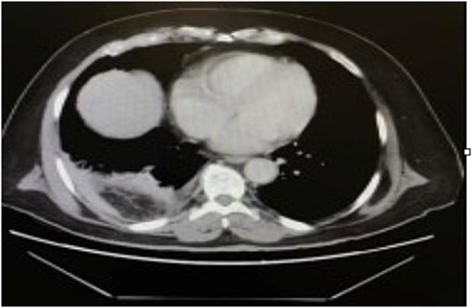 CT scan of the thorax revealed a right-sided pleural effusion and adjacent atelectasis.