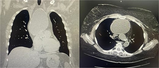 Coronal and axial views of a non-contrast CT of the chest demonstrating a large fluid density in the anterior mediastinum with rim calcification, subtle septations, and some nodularity, measuring 7.1 × 9.2 × 11.2 cm, accompanied by multiple small bilateral pulmonary nodules.