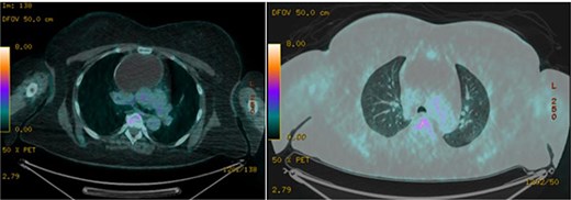 Axial images of PET/CT demonstrating a photopenic mass in the anterior mediastinum measuring 7.0 × 9.4 cm.