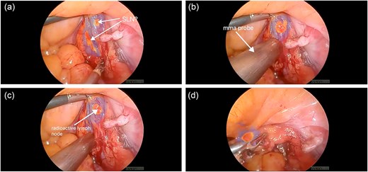 (a) ICG-positive node was visualized; (b, c) gamma probe enabled precise localization of SLN; (d) ICG and Tc99m-positive node was removed.