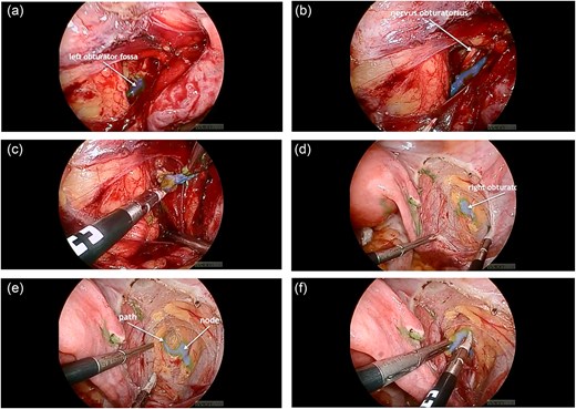 (a) ICG-positive node was visualized in the left obturator fossa; (b) visualization of the left obturator nerve next to the node; (c) node removal on the left side; (d) visualization of the ICG-positive node and the right obturator nerve in the right obturator fossa; (e) the lymphatic path to the node was visualized; (f) node removal on the right side.