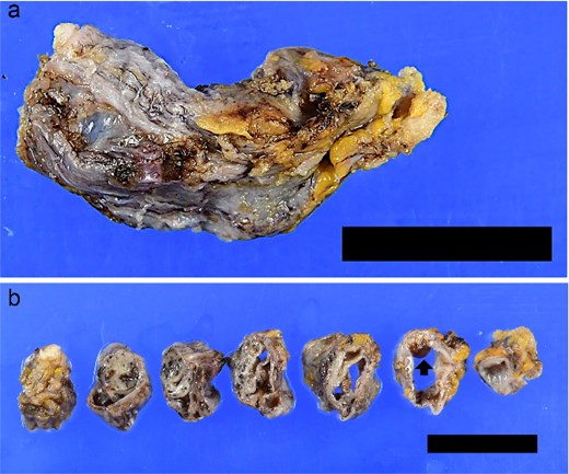 Macroscopic view of the resected specimen. (a) The resected tissue showed a sheath-like appearance. (b) On cross-section, the lesion consisted of branched canal with partial dilatation. A small dark-brownish mural protuberance (arrow) was noted. (a and b) bar = 2 cm.