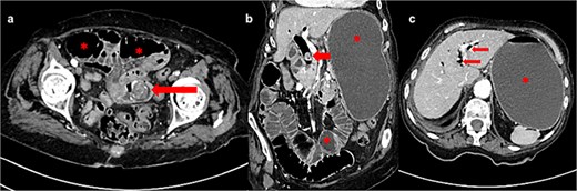 (a) Axial CT image shows gallstone in jejunum (arrow) and dilated bowel loops proximally (asterisk); (b) frontal CT image shows dilated stomach and bowel loops (asterisk) and gallstone in dilated common bile duct (arrow); (c) axial CT image shows pneumobilia (arrows) and fluid-filled and dilated stomach (asterisk).