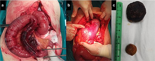 (a) Dilated bowel loops with ischemic part adjacent to the gallstone (pointed by grasper); (b) massively dilated stomach; (c) stones found in the jejunum (the larger one) and the common bile duct (the smaller one).