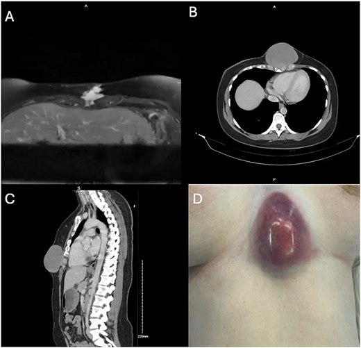 A: MRI axial plane. T2 weighted image. B, C: Non-contrast CT, axial and sagittal planes. D: Photograph of tumor at time of incisional biopsy.