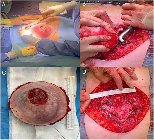 A: Incision around tumor with wide margin. B: Costal resection. C: Resected specimen. D: Large (14 × 12 cm) anterior thoracic defect.