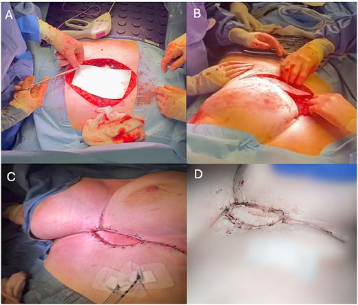 A: Chest wall reconstruction with Permacol mesh. B: Tunneled pedicled latissimus dorsi flap. C: Closure. D: Wound reviewed at ten days post-operatively.