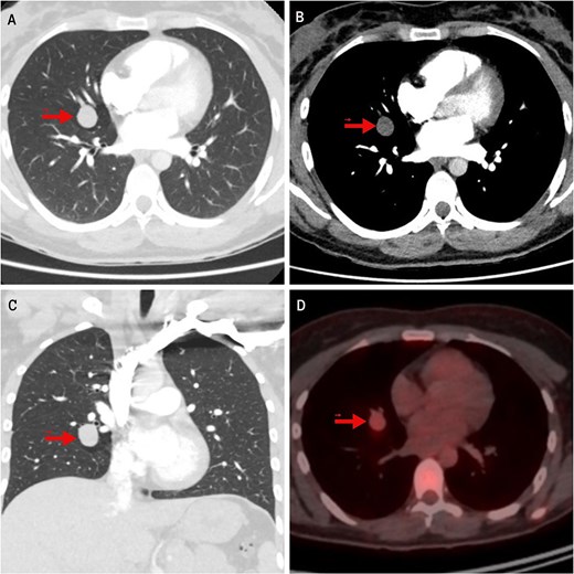 Imaging findings of the pulmonary carcinoid tumor. Contrast-enhanced chest CT. (A, B) Axial views (lung and mediastinal windows); (C) Coronal view (lung window); (D) FDG-PET scan. The arrow indicates a well-circumscribed, round lesion measuring 16 × 19 × 17 mm, with soft tissue density, centrally located in the medial segment of the right middle lobe, and showing mild hypermetabolism on image (D).
