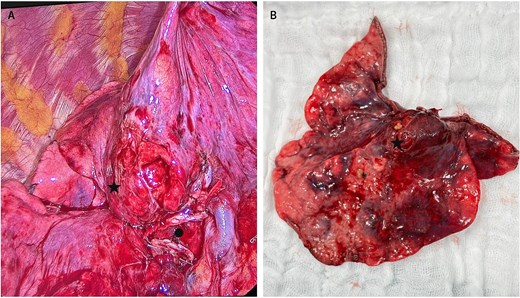 Intraoperative view of the atypical carcinoid tumor in the middle lobe. (A) Marked with ● middle lobe hilum transected with a stapler; to its right, part of the intact hilum of the right upper lobe. (A, B) Marked with ★ carcinoid tumor.