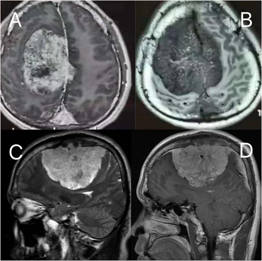 Preoperative MRI: (A, B) axial post-contrast T2-weighted and T1-weighted, respectively (C, D) sagittal position post-contrast T2-weighted and T1-weighted, respectively. The MRI findings describe a lesion in the right frontoparietal region adjacent to the superior sagittal sinus, measuring ~8.6 × 8.2 × 6.9 cm. The lesion demonstrates long T1 and T2 signal characteristics and exhibits marked heterogeneous enhancement on contrast-enhanced scans. It encircles the superior sagittal sinus and extends across the cerebral falx to the contralateral side, with multiple tortuous flow-void vascular shadows observed within and around the lesion. The mass is broadly attached to the adjacent calvarium, invading the diploic layer of the skull. Posteriorly, it extends along the superior sagittal sinus to the origin of the left transverse sinus. Compression of adjacent brain parenchyma results in irregular narrowing of the lateral ventricle and leftward shift of midline structures. Additionally, the cerebellar tonsils appear pointed and inferiorly displaced.