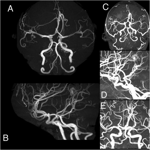 (A–E) Angiography demonstrates a hypervascular space-occupying lesion supplied by branches of the right anterior cerebral artery, right middle meningeal artery, right superficial temporal artery, left anterior cerebral artery, left middle meningeal artery, and left superficial temporal artery.