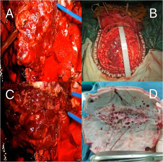 (A–C) Showing the tumor is large in size, rich in blood supply, and unclear demarcation from the surrounding tissues, occupying the entire cranial roof. (D) Extensive erosion of the skull.