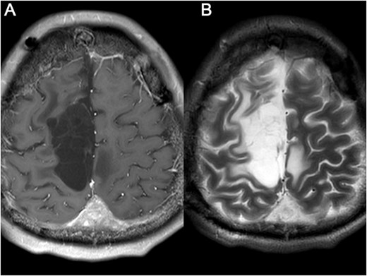 Brain MRI was re-examined after 5 months (A) and 17 months later (B), respectively, and showed that the residual tumor had not progressed and no other recurrence lesions were found.