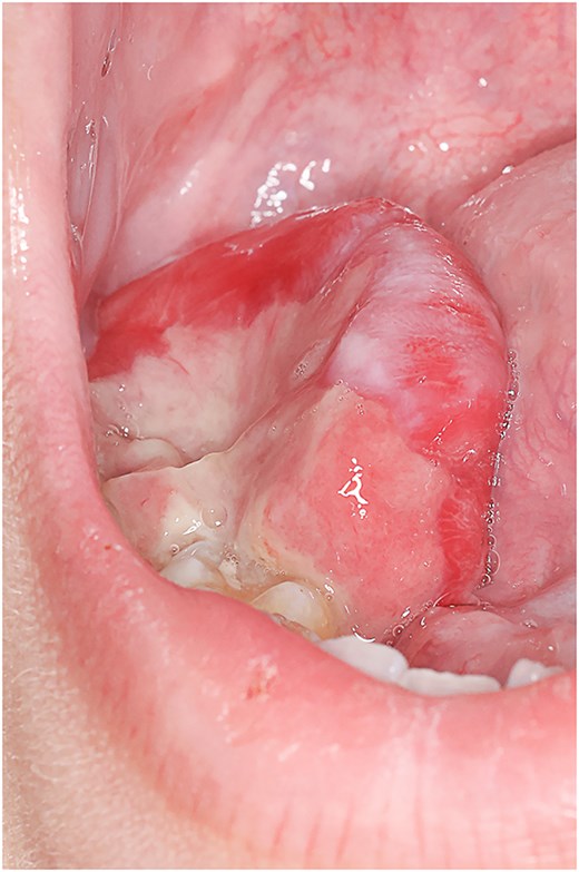 Right-sided sublingual swelling extending into the inferior alveolus, displacing the third lower molar tooth. The mass measured ≈ 5 × 6 × 4 cm.