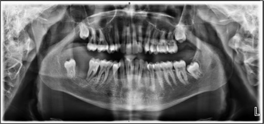 XR OPG showing displacement of the second and third molars and a poorly defined superior margin of the alveolar process, suggesting osseous involvement