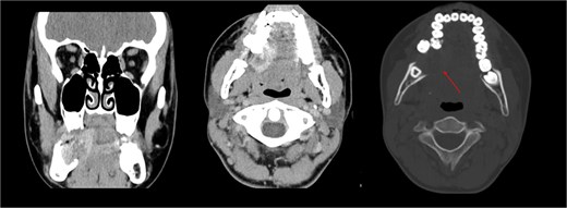 CT showing well defined lucent lesion within the body of the right side of the mandible with exophytic soft tissue component extending into oral cavity.