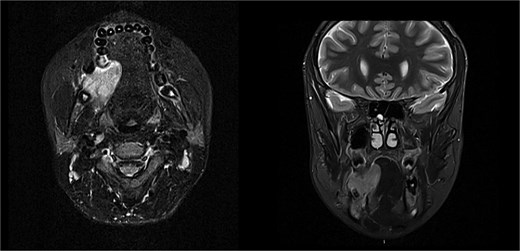 Solid enhancing right osteolytic mandibular lesion with small necrotic components within it. Infection/abscess less likely due to absence of fat stranding/rim enhancement (MRI).