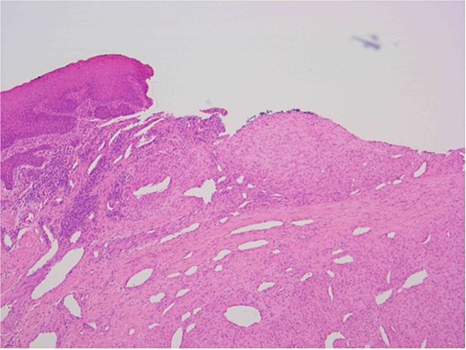 Oral squamous mucosa with underlying bland spindle cell proliferation showing fascicular growth and dilated haemangiopericytoma-like vessels and a myoid nodule centrally.