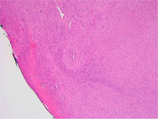 Ulcerated area with underlying bland spindle cell proliferation showing fascicular growth impression of cellularity involving vascular wall – haemangiopericytoma-like architecture (central).