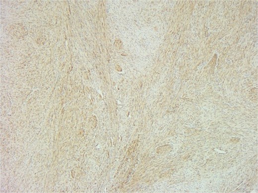 SMA immunostain showing diffuse positivity in spindle cells and highlighting myoid nodules.