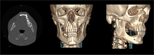 CT with reconstruction, showing no recurrence of myofibroma.