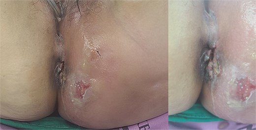 Patient images of Fournier’s gangrene with multifocal necrotizing fasciitis.