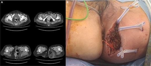 (A) Abscess formation with emphysema in the left perineum and buttock on abdominal pelvic CT scan. (B) Postoperative images after incision and drainage.