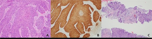 (A) Histopathologic features of anal cancer showing infiltrating non-keratinizing squamous cell carcinoma. (B) Diffuse and strong ‘block-type’ p16 immunoreactivity is observed in the tumor nests. This finding was also confirmed by PCR for HPV type 16. (C) Metastatic squamous cell carcinoma showing histologic features similar to the primary anal cancer is identified in a supraclavicular lymph node (original magnification, ×100).