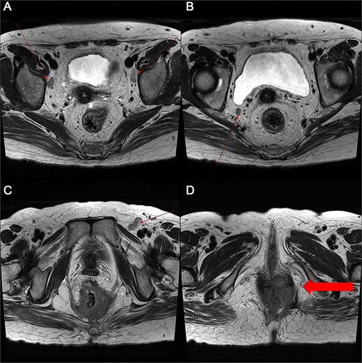 Pelvic MRI demonstrating the progression and extent of perineum and pelvic involvement. (A–C) Indeterminate lymph nodes in the bilateral external iliac chains, right obturator chain, and bilateral inguinal chains (thin arrow). (D) Presence of anorectal cancer with invasion of both levator muscles (thick arrow).