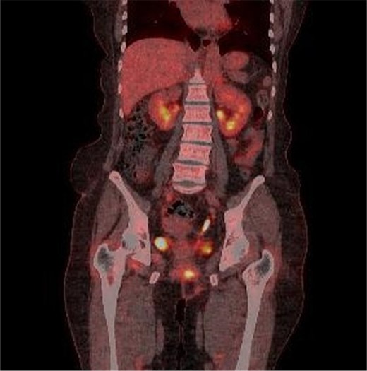 Multiple intense hypermetabolic mass lesions identified from the anus to the rectum, accompanied by numerous hypermetabolic lymph nodes in the pelvis.