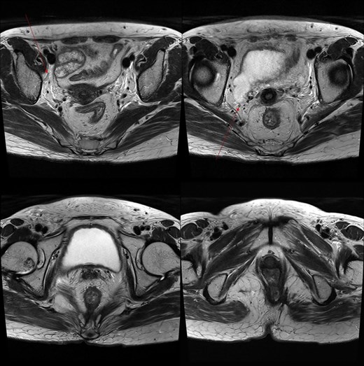 Marked reduction in the size of the tumor and lymph nodes following CCRT.